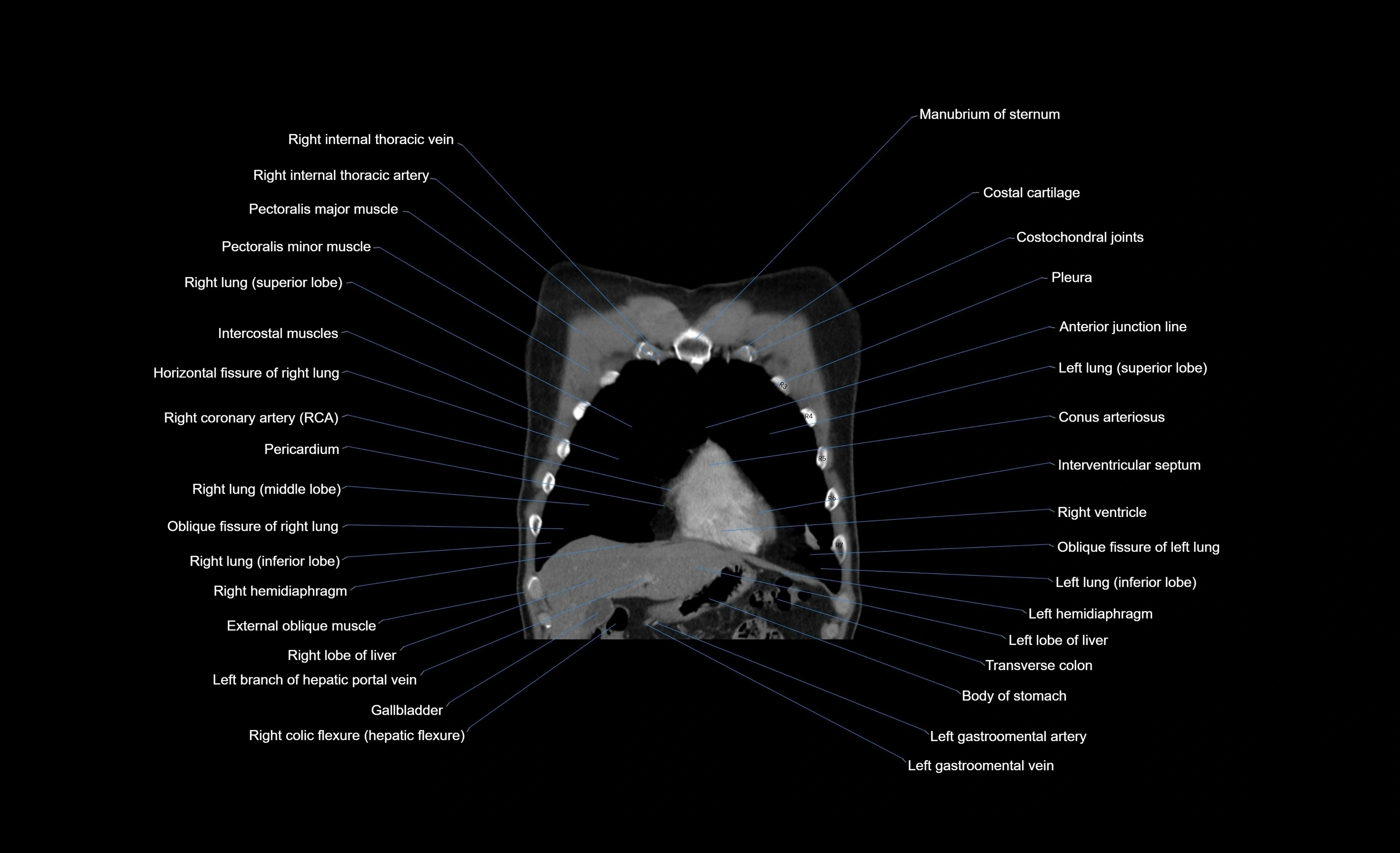 CT chest (thorax) soft tissue window labelled coronal cross sectional anatomy radiology image-00091.webp